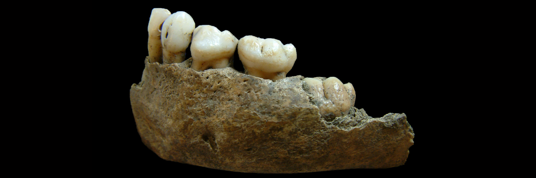A close up of a lower jawbone with deformed teeth